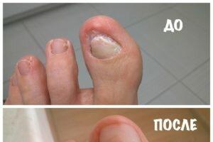 Как лечить пожелтевшие и утолщающиеся ногти на ногах